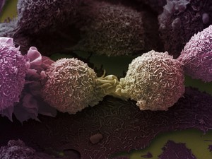 view Lung cancer cells.