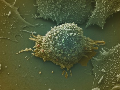 Lung cancer cell.