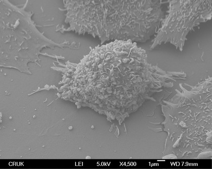 Lung cancer cell.