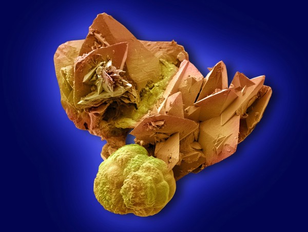 Kidney Stone crystals