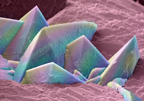 Kidney stone crystals