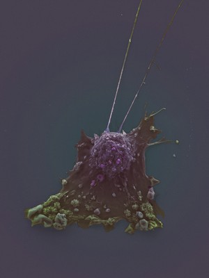 view coloured breast cancer cell