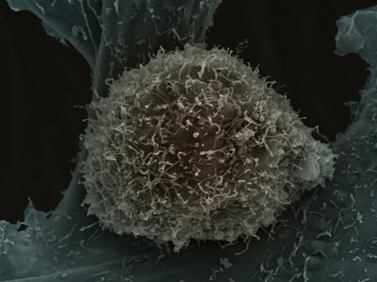 Prostate cancer cell