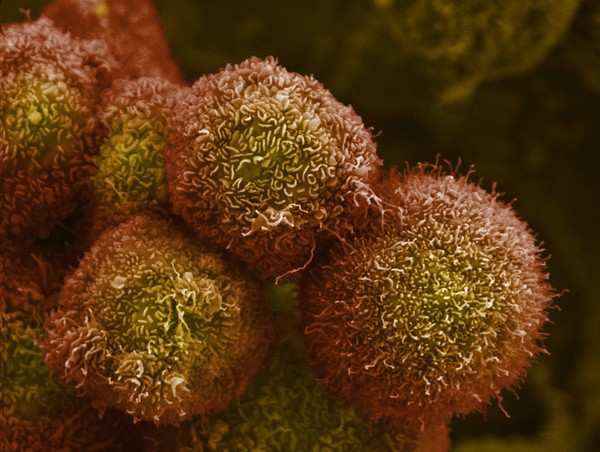 Pancreatic cancer cells