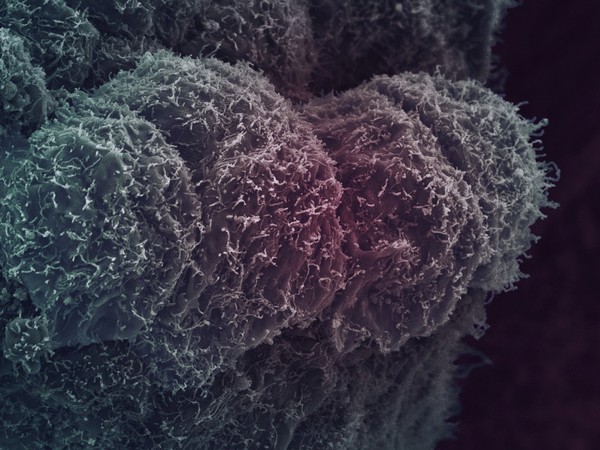 Prostate cancer cells