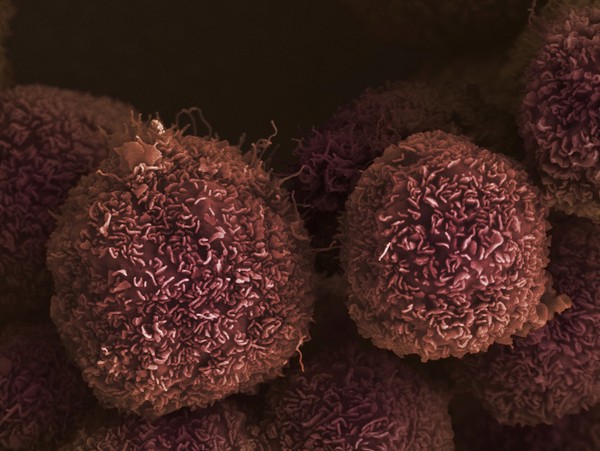 Pancreatic cancer cells