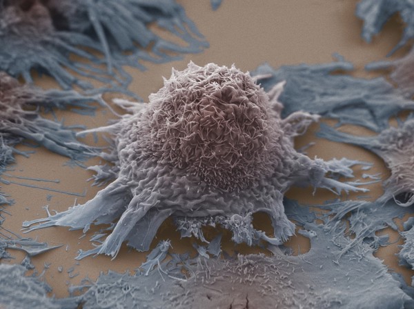 Lung cancer cell