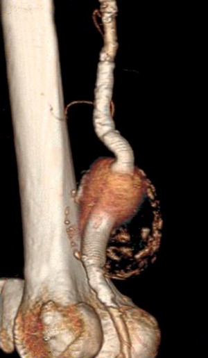 view Popliteal aneurysm: reconstructed CT scan