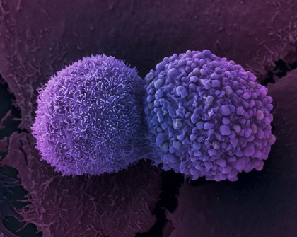 Lung cancer cells