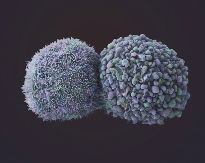 Lung cancer cells