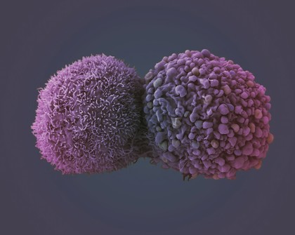 Lung cancer cells