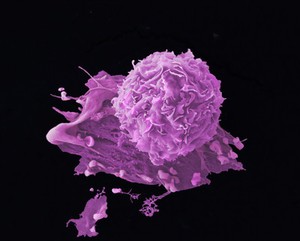 view Breast cancer cells