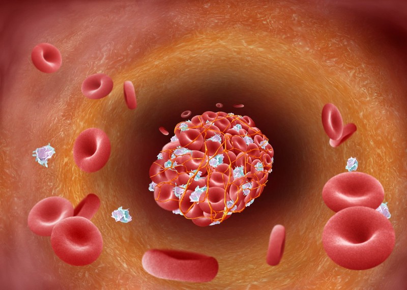 Blood clot forming in arterial plaque Collection