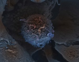 view Breast cancer cell