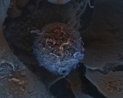 Breast cancer cell