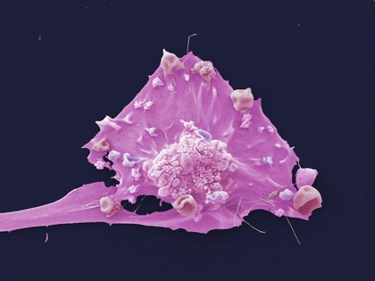 Breast cancer cell