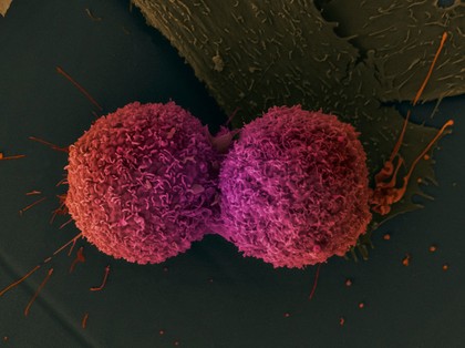 Lung cancer cells