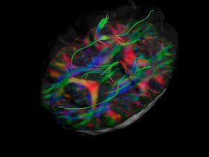 view White matter fibres of the uncinate fasciculus