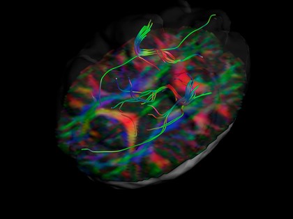 White matter fibres of the uncinate fasciculus