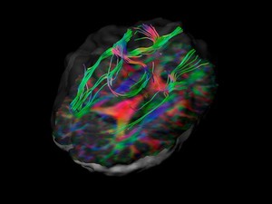 view White matter fibres of the uncinate fasciculus