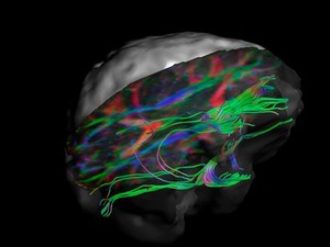 view White matter fibres of the uncinate fasciculus