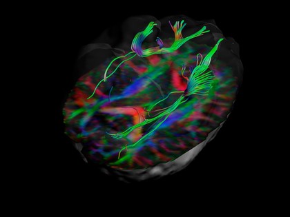 White matter fibres of the uncinate fasciculus