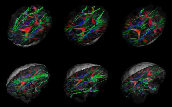 White matter fibres of the uncinate fasciculus