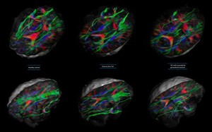 view White matter fibres of the uncinate fasciculus