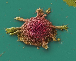 view Lung cancer cell