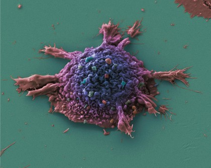 Lung cancer cell