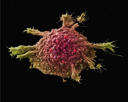 Lung cancer cell