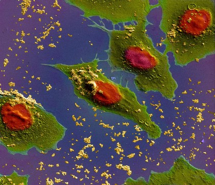 Lung cancer cells treated with nano sized drug carriers