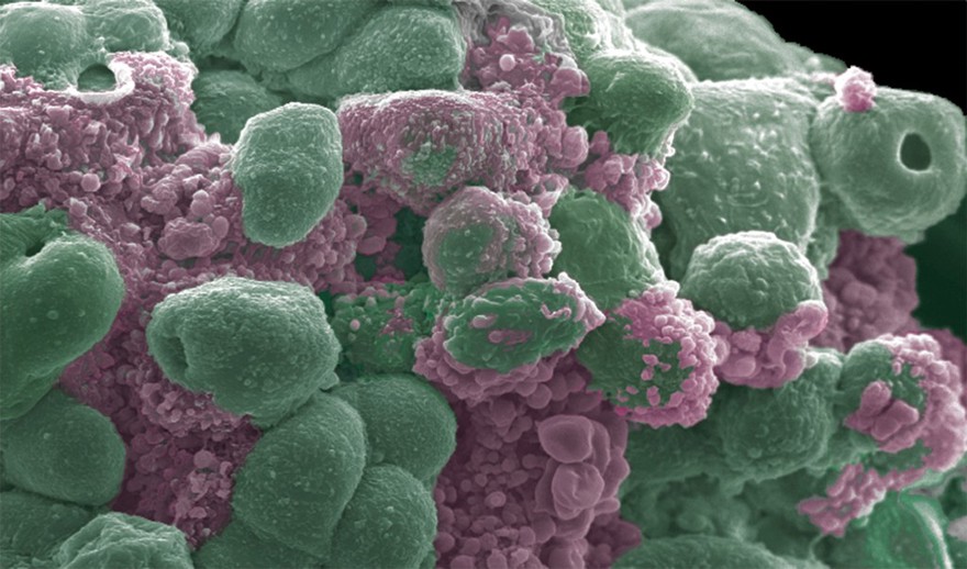 Prostate cancer cells treated with nano sized drug carriers