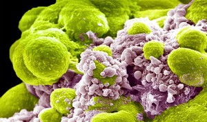 view Prostate cancer cells treated with nano sized drug carriers