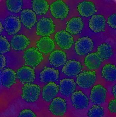 Prostate cancer cells treated with nano sized drug carriers