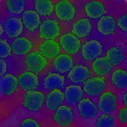 Prostate cancer cells treated with nano sized drug carriers