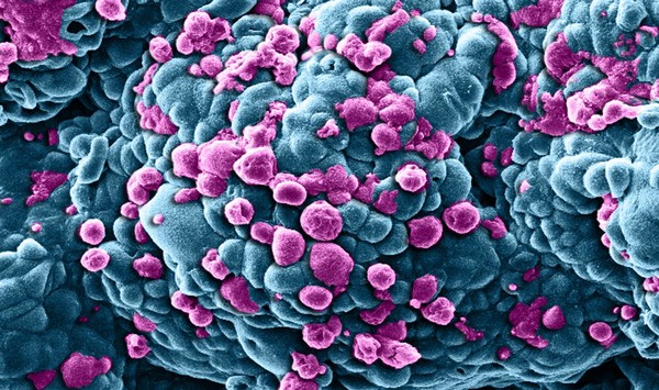 Breast cancer cells treated with nano sized drug carriers.