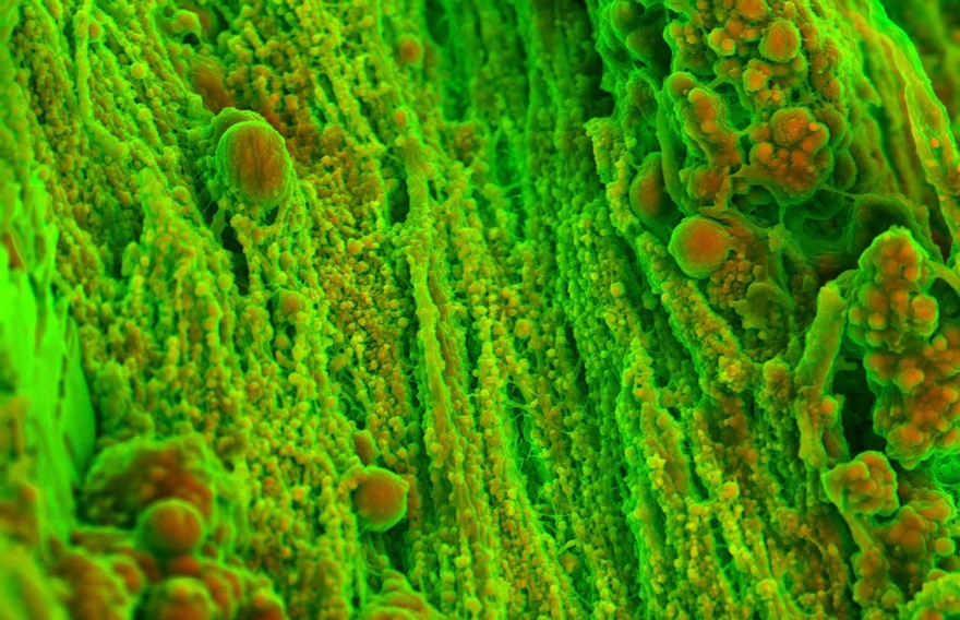 Human heart (aortic valve) tissue displaying  calcification.