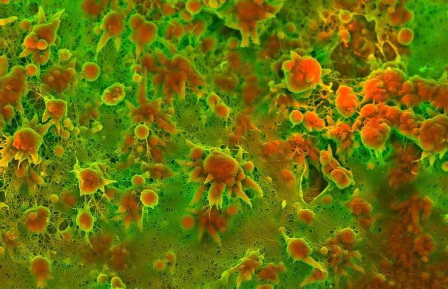 Human heart (aorta) tissue displaying calcification