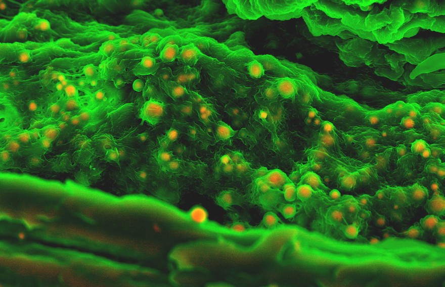 Human heart (aortic valve) tissue displaying calcification
