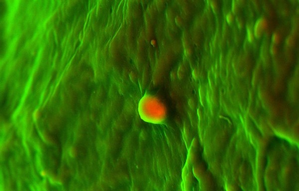 Human heart (aortic valve) tissue displaying calcification