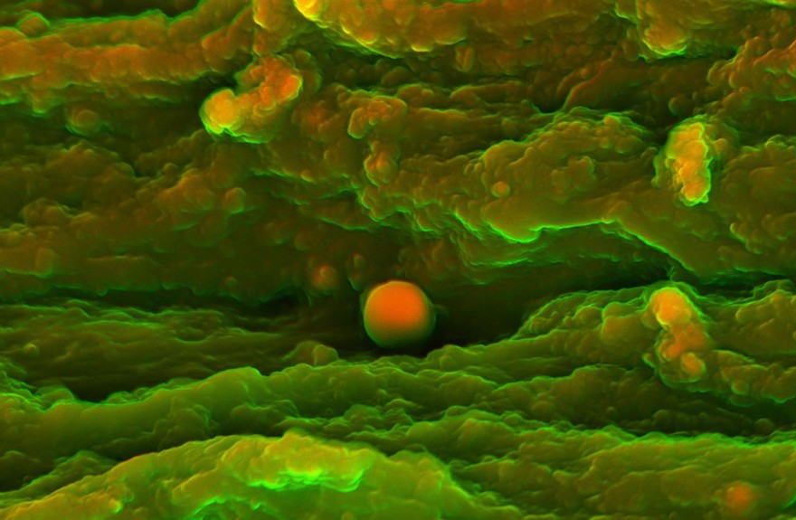 Human heart (aortic valve) tissue displaying calcification