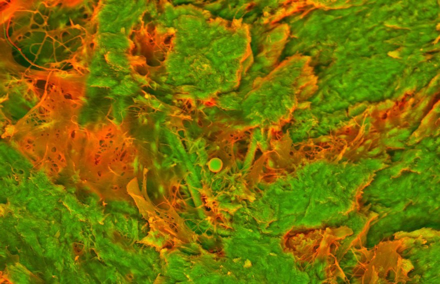 Human heart (aorta) tissue displaying calcification