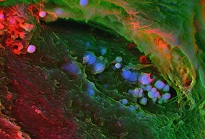 view Human heart (mitral valve) tissue displaying calcification