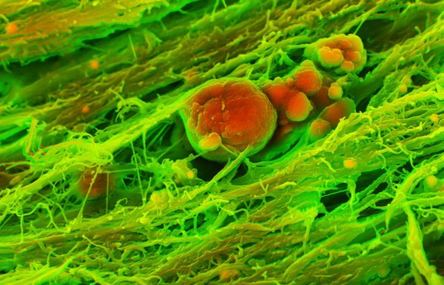 Human heart (aortic valve) tissue displaying calcification