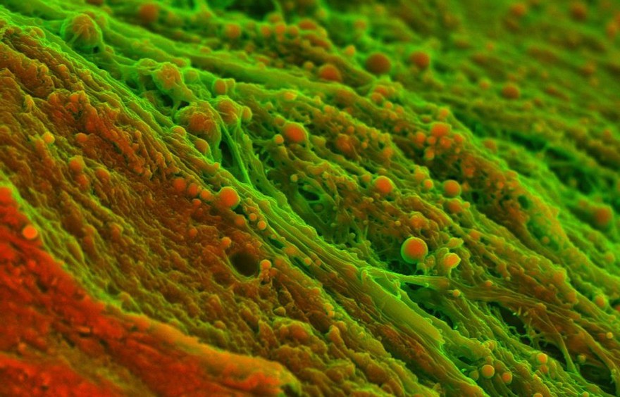 Human heart (aortic valve) tissue displaying calcification