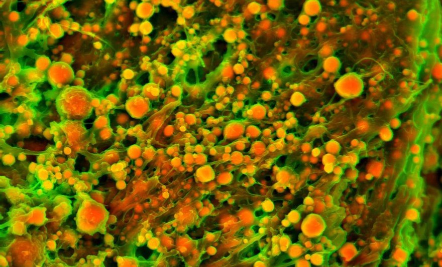 Human heart (aortic valve) tissue displaying calcification
