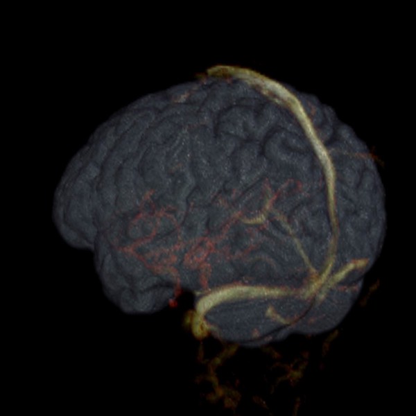Brain and blood vessels of a healthy female adult, MRI