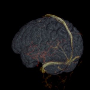 view Brain and blood vessels of a healthy female adult, MRI