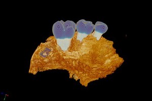 view Medieval human maxilla (upper jaw bone)